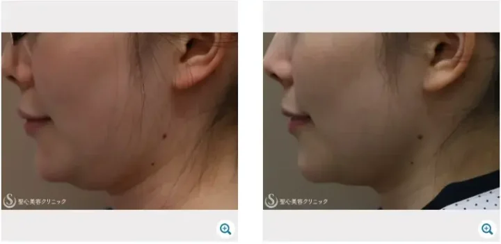 聖心美容クリニック ハイフ症例写真