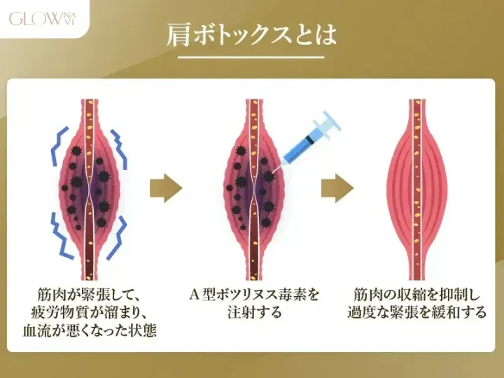 肩ボトックスとは