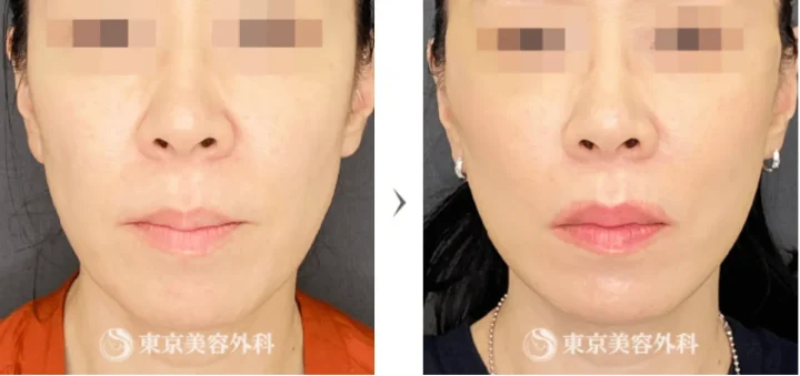 東京美容外科　糸リフト　症例写真