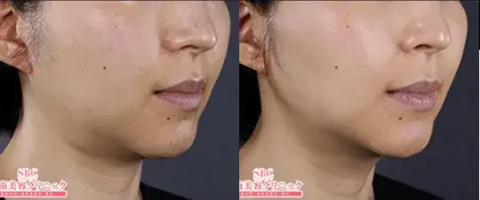 湘南美容 ハイフ症例写真