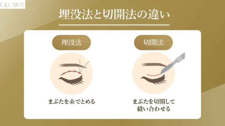 埋没法と切開法の違い-1