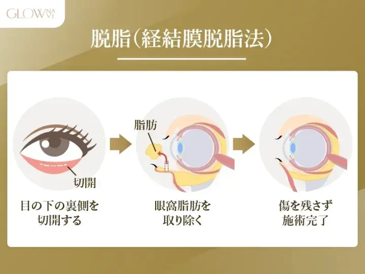 脱脂法