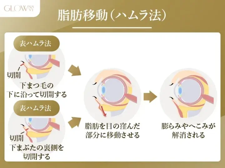 ハムラ法