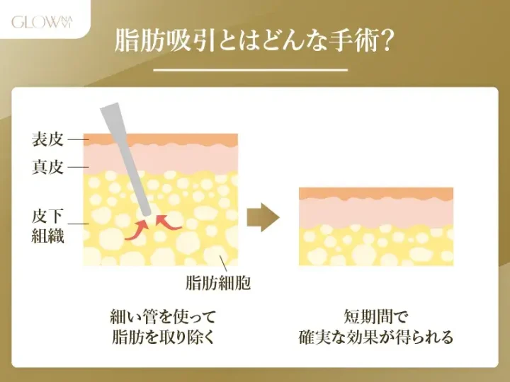 脂肪吸引とはどんな手術？