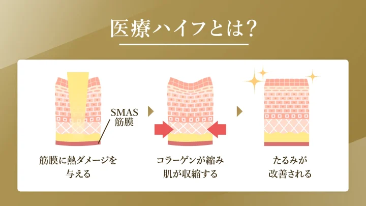 医療ハイフとは