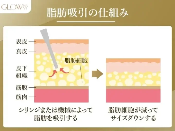 脂肪吸引の仕組み