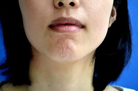 梅干しジワを治す3つの方法 | 笑顔表情筋®協会