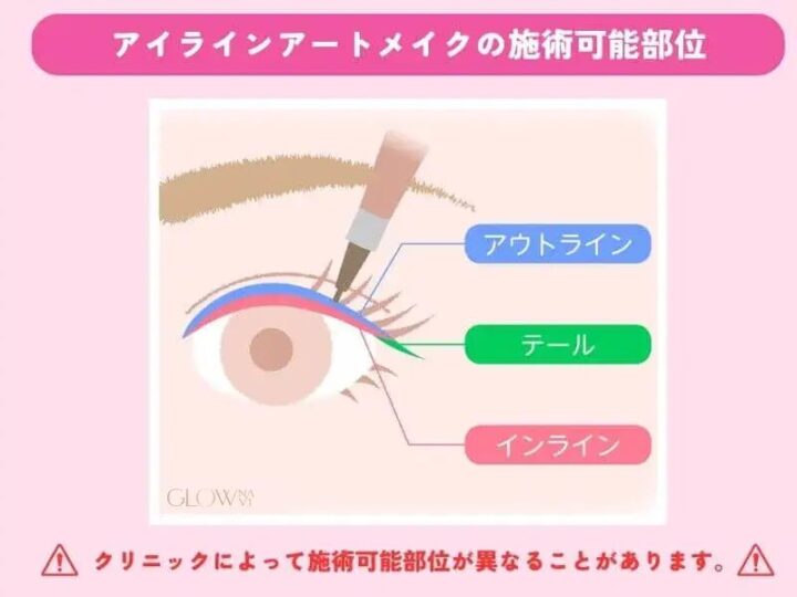 アイラインアートメイクの施術可能部位