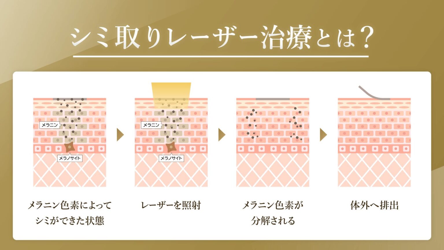 シミ取りレーザーおすすめクリニック13選！賢い選び方と施術・費用 | GLOW NAVI