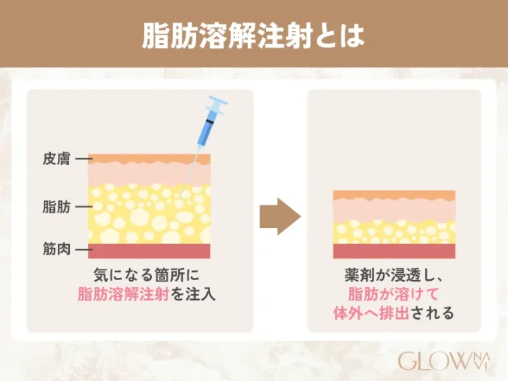 脂肪溶解注射