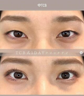 TCB式1dayクイックアイ