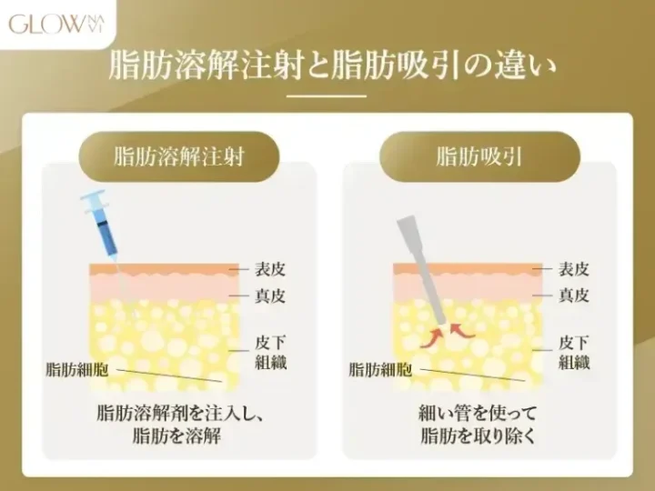 脂肪溶解注射と脂肪吸引の違い
