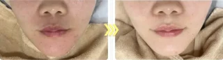 ダーマペン