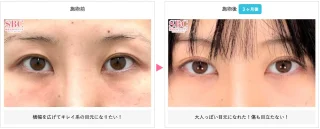 目頭切開プレミアム