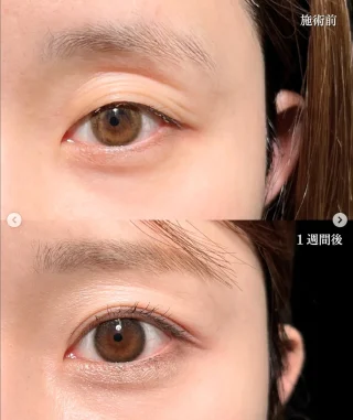 二重埋没(クイックシンデレラ・ダブル)