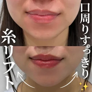 糸リフト