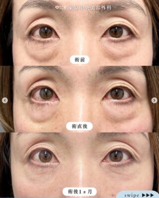 切らない目の下のクマ取り・ヒアルロン酸(目の下)・クマ取り再生注射