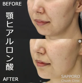 顎ヒアルロン酸