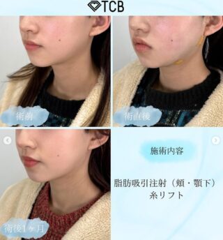 TCB式⼩顔美肌再⽣
