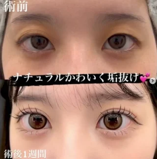 オーダーメイド二重整形