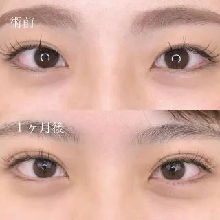 二重埋没法