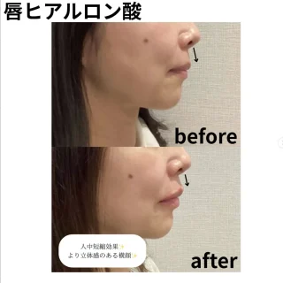 唇ヒアルロン酸