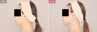 ベイザー脂肪吸引(頬＋あご下)