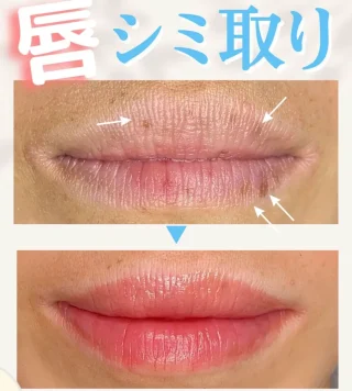 ピコスポット