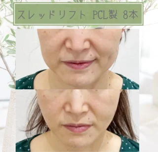 スレッドリフト