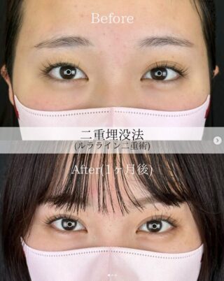 二重埋没法(ルラライン二重術)