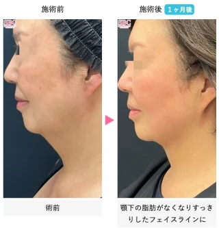 美ボディ脂肪吸引