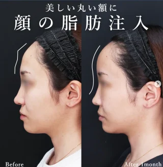 顔の脂肪注入(コンデンスリッチフェイス)