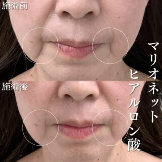 マリオネットライン（口元のしわ）ヒアルロン酸注射