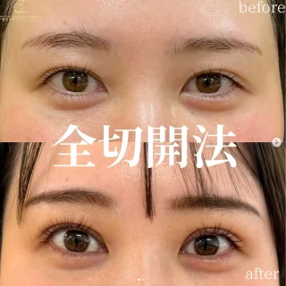 「全切開法」+「眼瞼下垂手術(埋没法)」