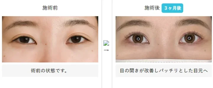 湘南美容クリニック 二重術 症例写真