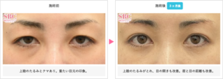 眉下リフト(眉下切開)&目の下の切らないクマ・たるみ(ふくらみ)取り&