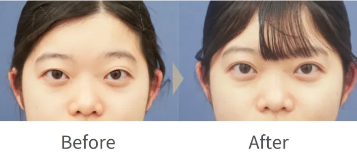 ガーデンクリニック 二重 症例写真