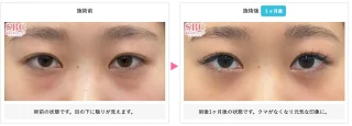 目の下の切らないクマ・たるみ（ふくらみ）取り