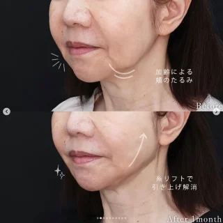 TAC式ツヤ肌コラーゲンリフト®極