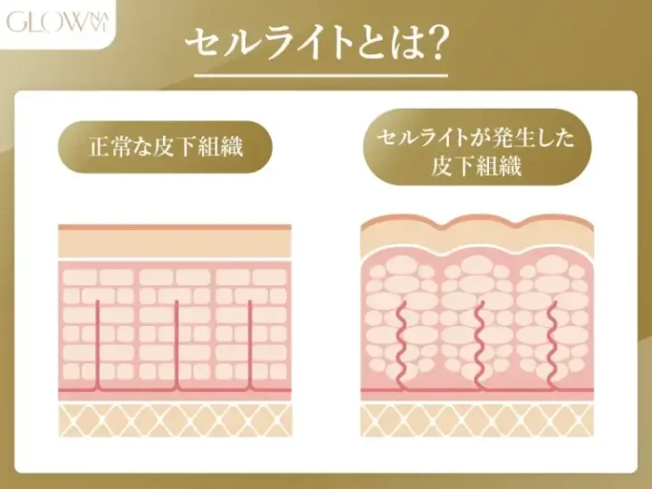 セルライトとは