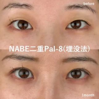 熊本美容外科NABEクリニック 二重