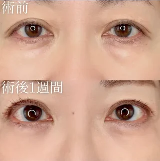 切らない目の下のクマ取り・たるみ取り