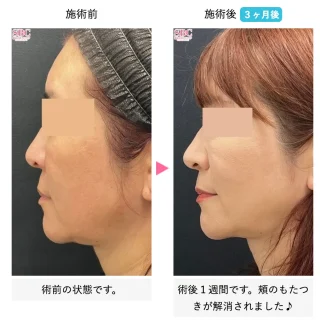 シークレットリフト