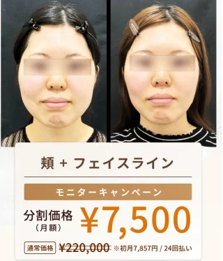 共立美容外科　小顔脂肪吸引
