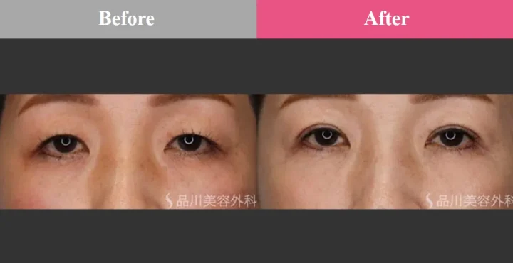 品川美容外科 二重術ナチュラル法 症例写真
