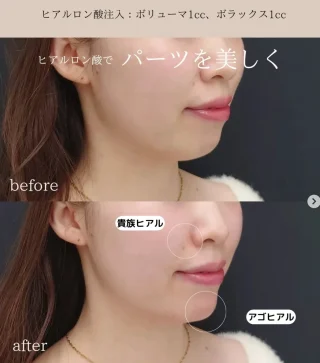 ヒアルロン酸注入