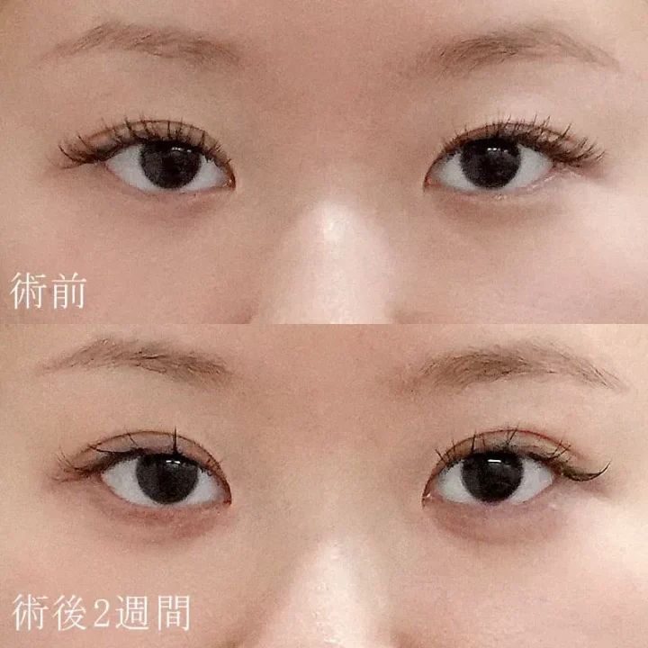 水の森美容クリニック 二重施術 症例写真