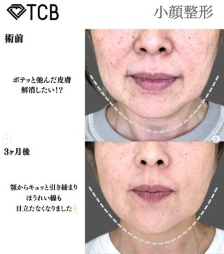 TCB小顔リフト
