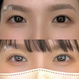 二重埋没法