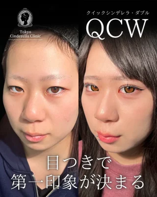 二重埋没(クイックシンデレラ・ダブル)